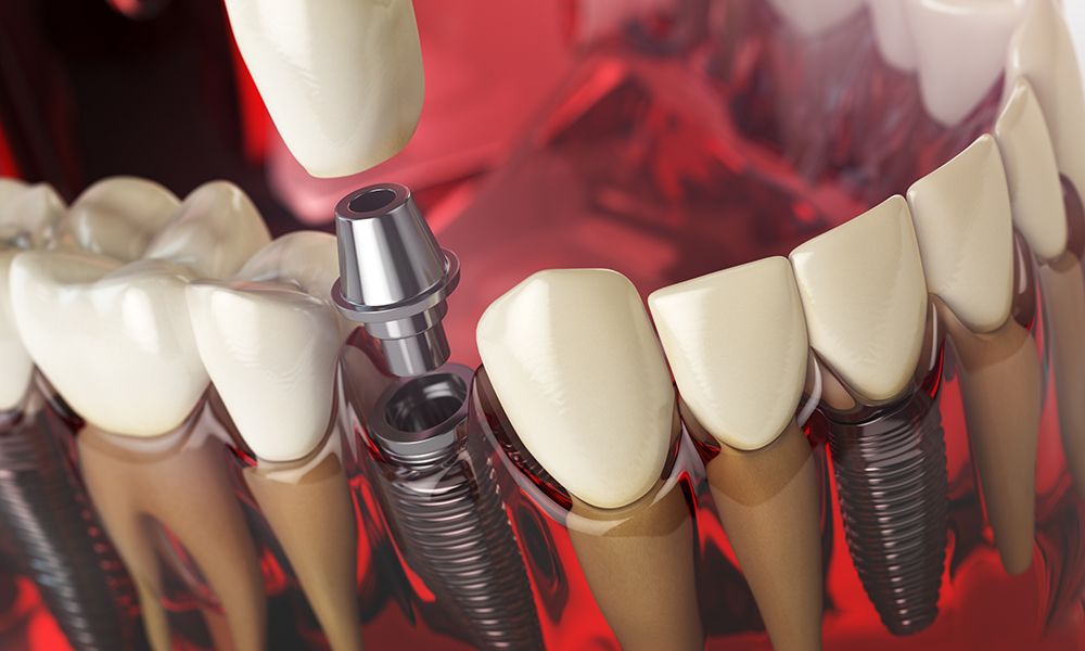 ilustración 3d de implante dental en el modelo de dientes humanos, encías y dentaduras postizas.